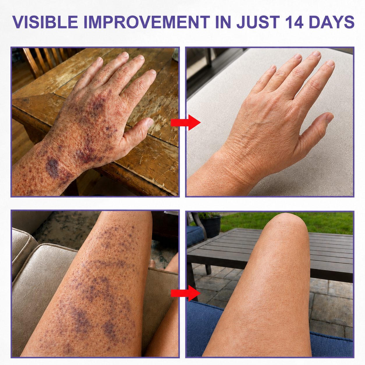 10K+ SOLD 🔥Dark Spot & Bruise Recovery Cream ✨  Helps Improve the Look of Dark Spots & Uneven Body Tone