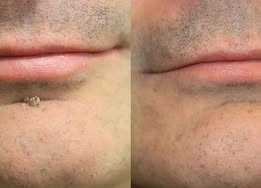 LIMETOW® 2-in-1 Microneedle & Hydrocolloid Patch🍀 | Removes Raised Moles, Acne, Flat Warts, Skin Tags, Milia & Age Spots | No Surgery Needed | Invisible Skin Treatment for Face & Body | 90-Day Money-Back Guarantee