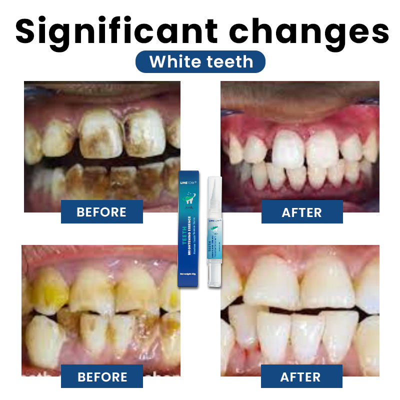 LIMETOW® Teeth Whitening Essence