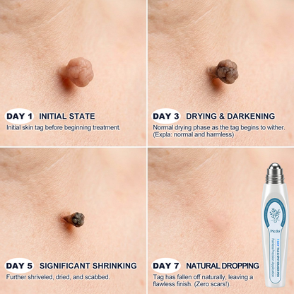 Skin Tag & Spot Eraser