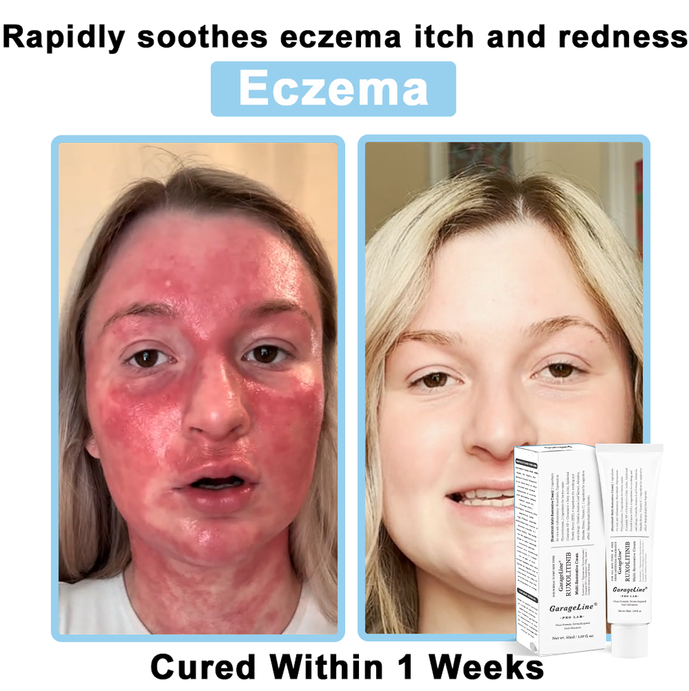【Official US Store🔥】JAK-Smart Ruxolitinib Repair Complex 🌿（Zero Inflammation, 72H Sustained Release | Acne Clear in 10 Days | 97.7% Redness Reduction | Clinically Tested）