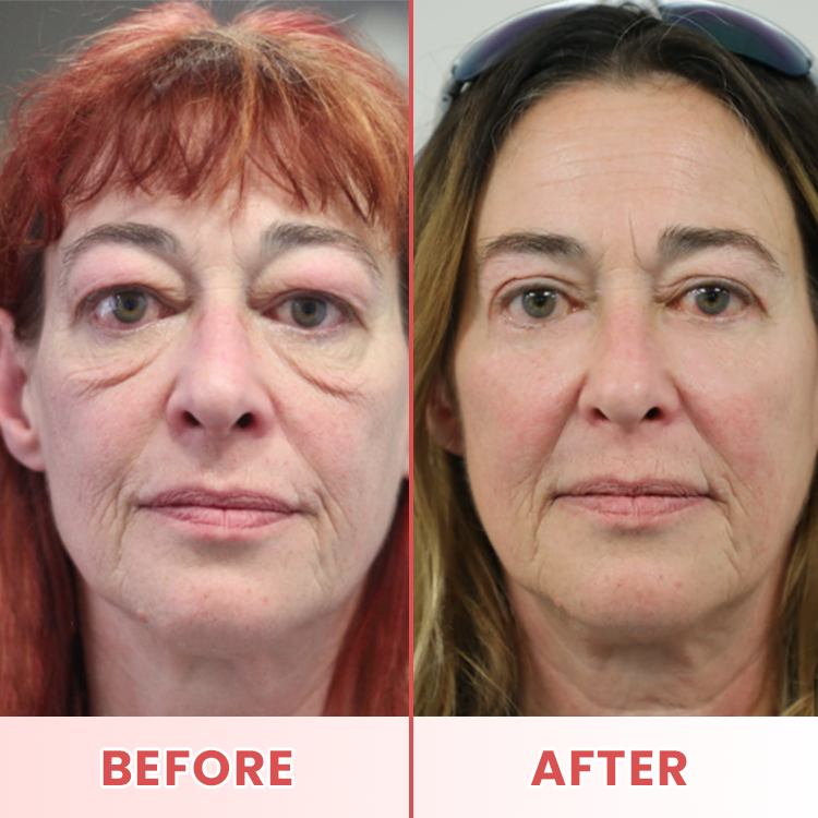 LIMETOW® Microneedle Patches for Eyebags and Dark Circles