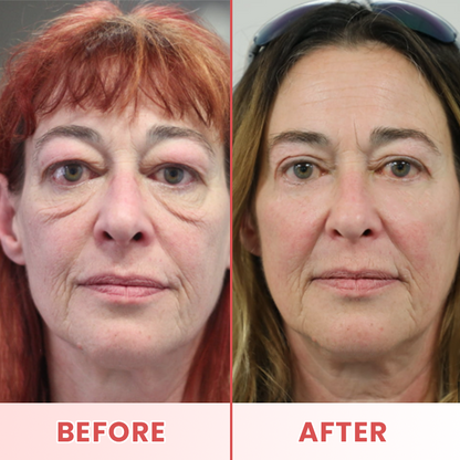LIMETOW® Microneedle Patches for Eyebags and Dark Circles