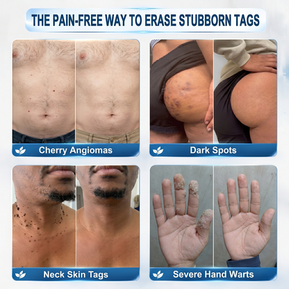Skin Tag & Spot Eraser