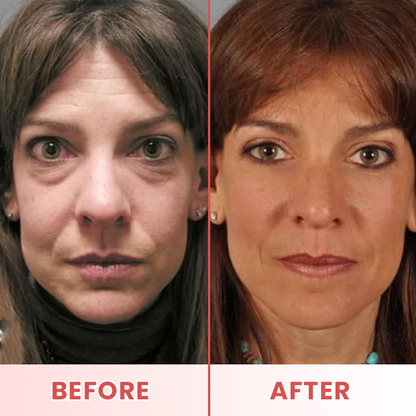 LIMETOW® Microneedle Patches for Eyebags and Dark Circles
