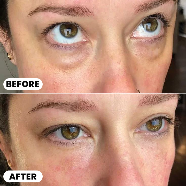 LIMETOW® Ultimate Depuff Eye Serum⚡Limited-Time Offer