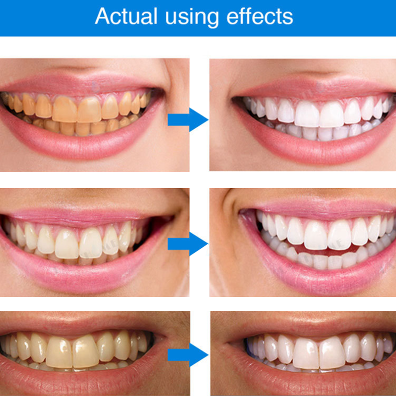 LIMETOW® Teeth Whitening Essence
