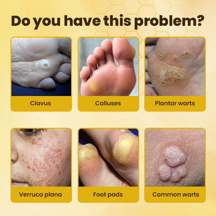 LIMETOW® Bee Venom Corn & Callus Remover Cream
