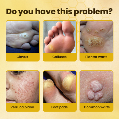 LIMETOW® Bee Venom Corn & Callus Remover Cream