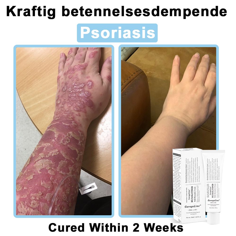 【Official US Store🔥】JAK-Smart Ruxolitinib Repair Complex 🌿（Zero Inflammation, 72H Sustained Release | Acne Clear in 10 Days | 97.7% Redness Reduction | Clinically Tested）