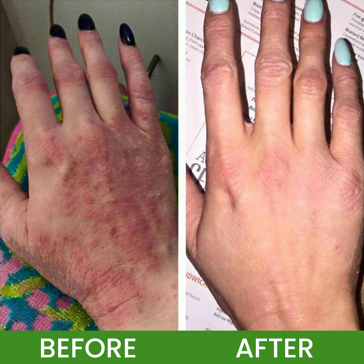 LIMETOW® Herbal Tinea Itching Cream image LIMETOW® Herbal Tinea Itching Cream