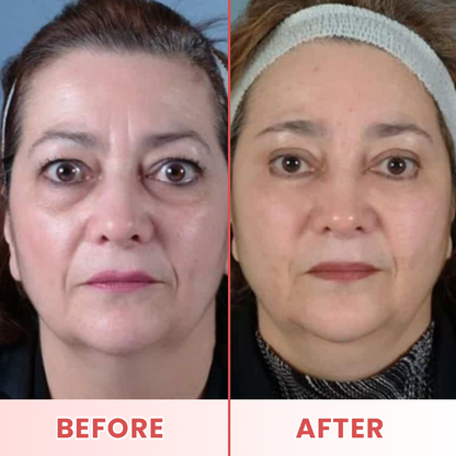 LIMETOW® Microneedle Patches for Eyebags and Dark Circles