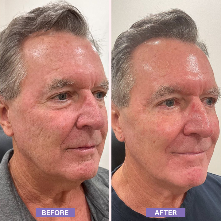 LIMETOW® Instant Lift Eye Gel