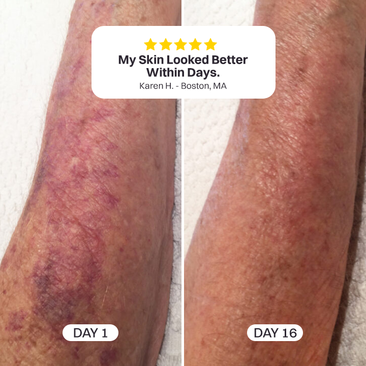 💥200K+ SOLD💕- LIMETOW® Bruise Repair & Skin-Strengthening Cream