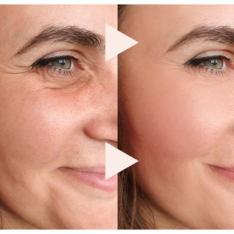 LIMETOW®The Express Anti-Wrinkle – Instant Lifting Effect