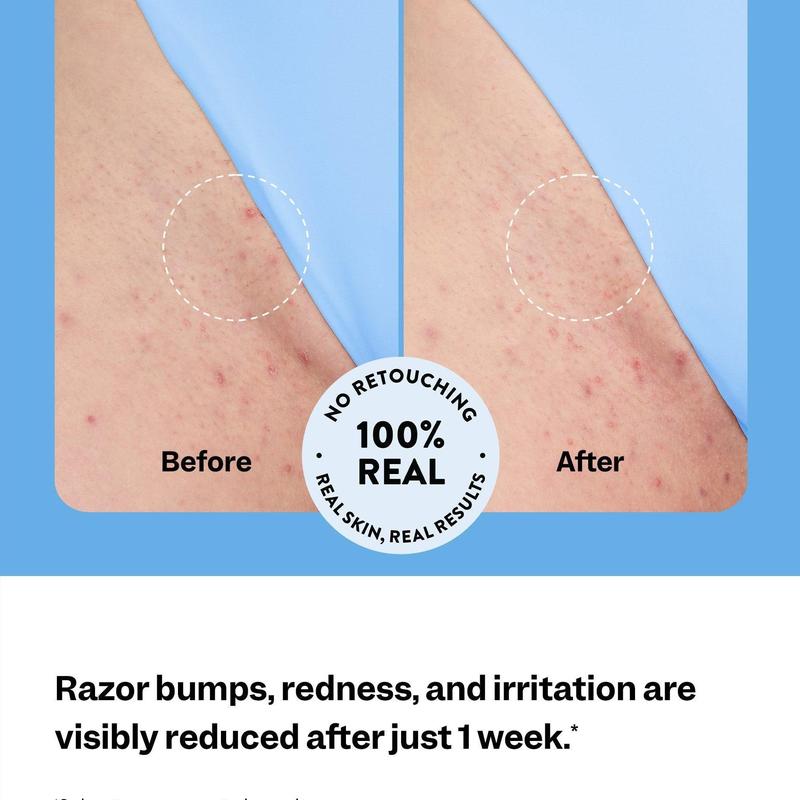 Smoothing Solution Ingrown Hair Treatment: Glide Your Way to Silky-Smooth, Bump-Free Skin