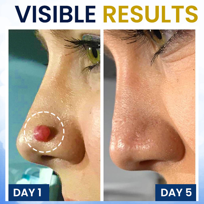 Skin Tag Cryo Treatment Spray
