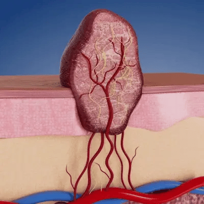 LIMETOW® 2-in-1 Microneedle & Hydrocolloid Patch🍀 | Removes Raised Moles, Acne, Flat Warts, Skin Tags, Milia & Age Spots | No Surgery Needed | Invisible Skin Treatment for Face & Body | 90-Day Money-Back Guarantee