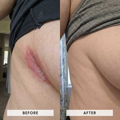 Skinfold Treatment