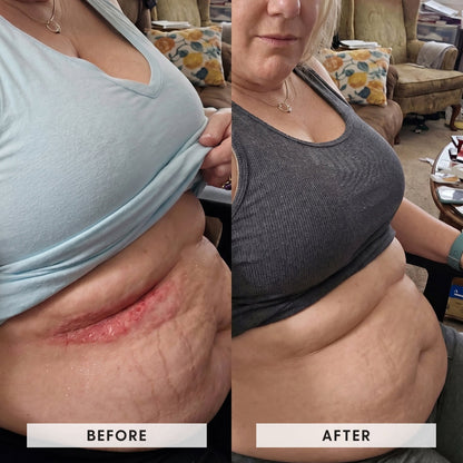 Skinfold Treatment