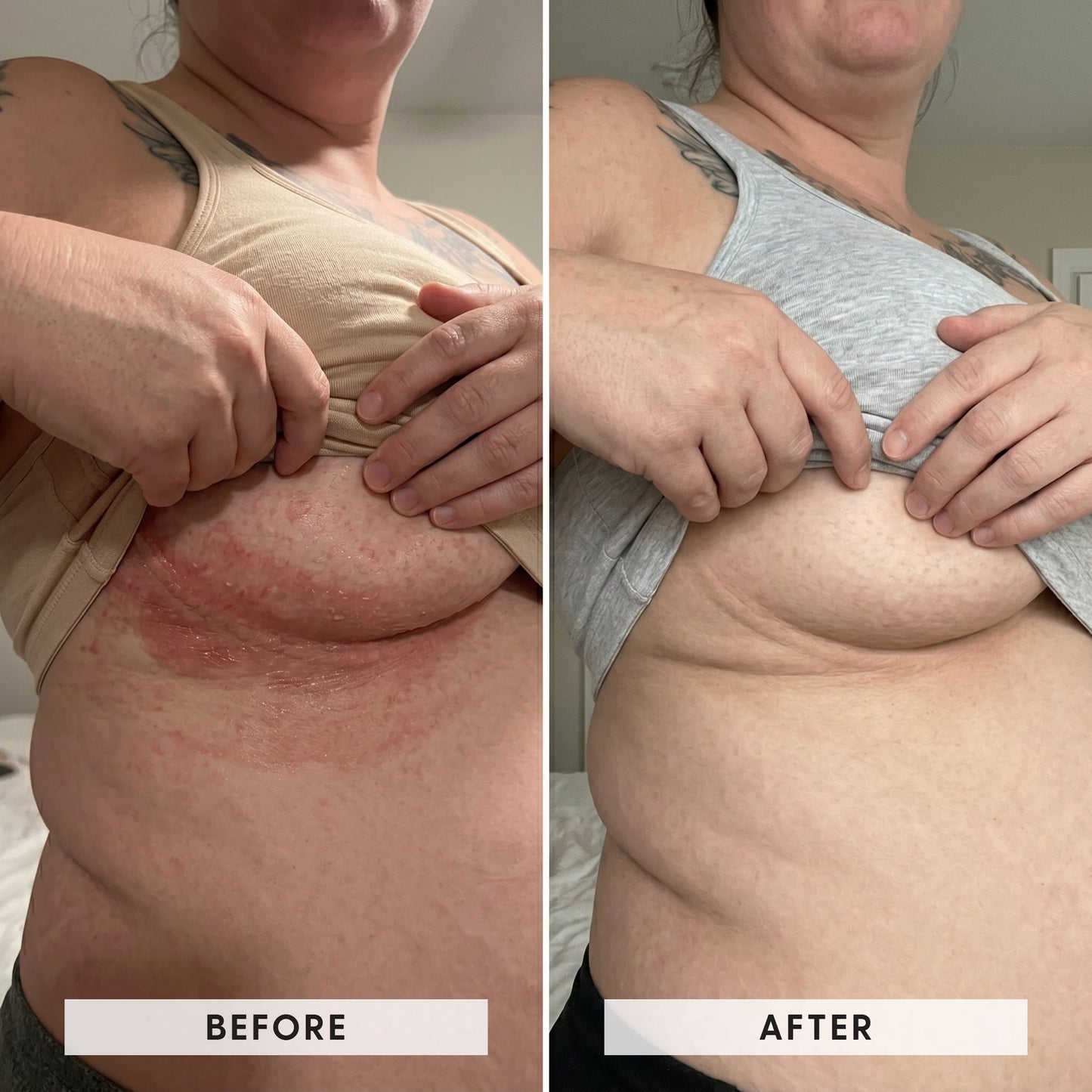 Skinfold Treatment