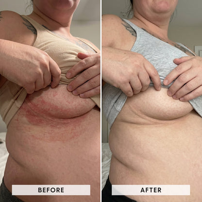 Skinfold Treatment