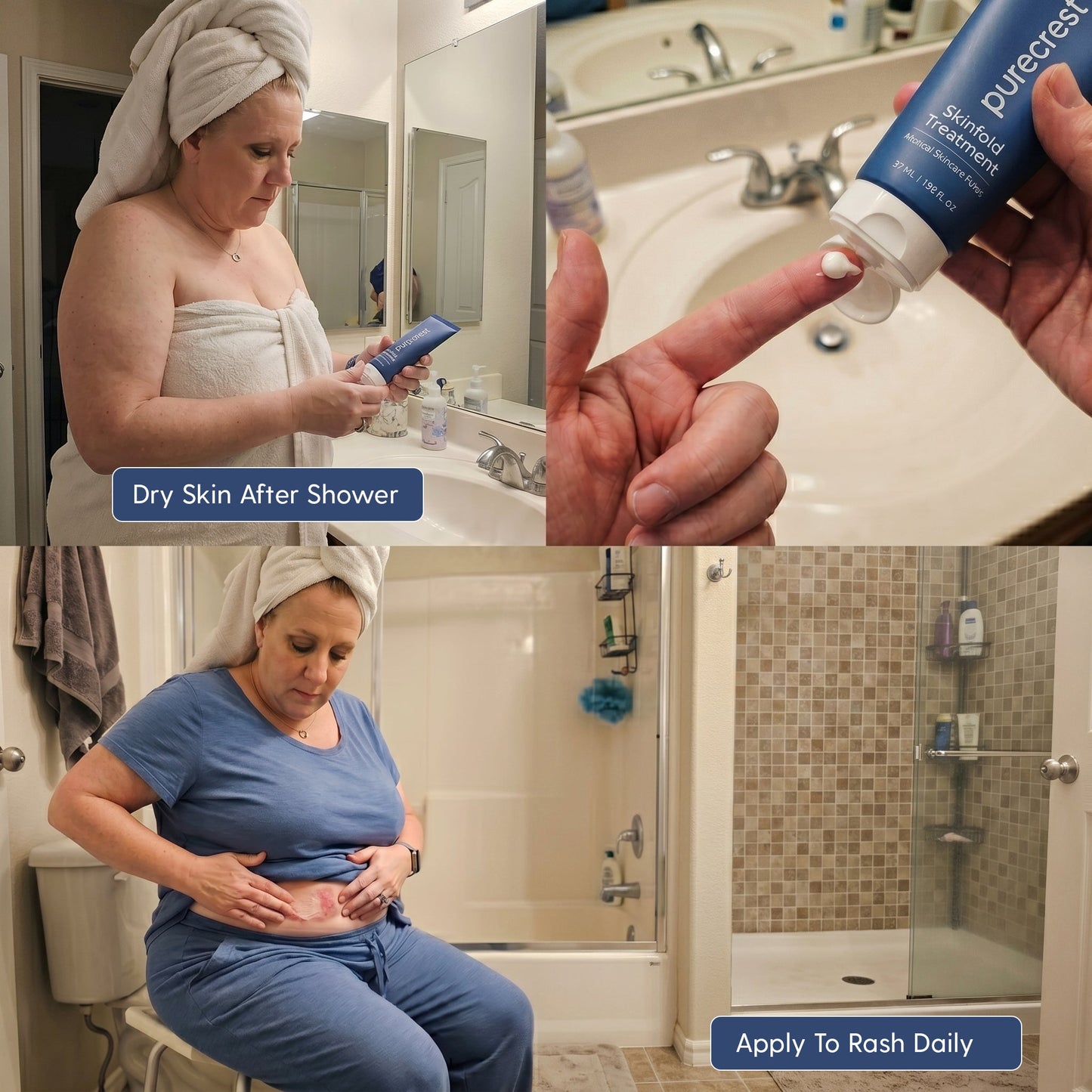 Skinfold Treatment