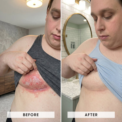 Skinfold Treatment