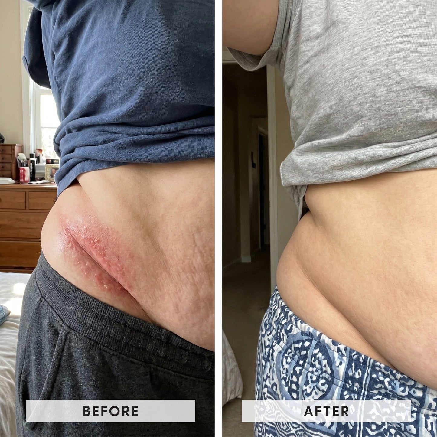 Skinfold Treatment