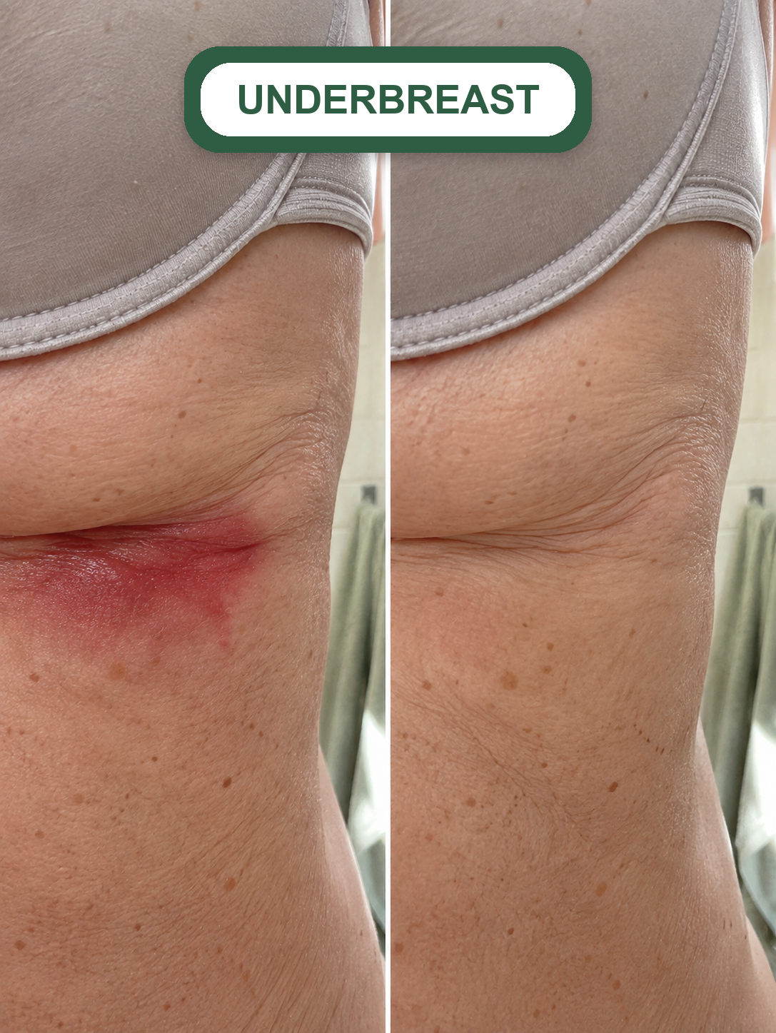 The only cream made for the skin fold itself, so the rash finally stops coming back.