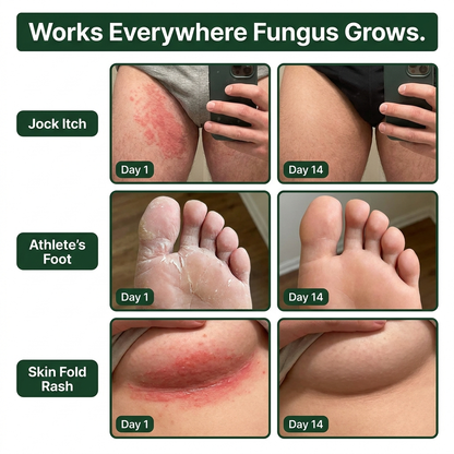 Antifungal Barrier Cream