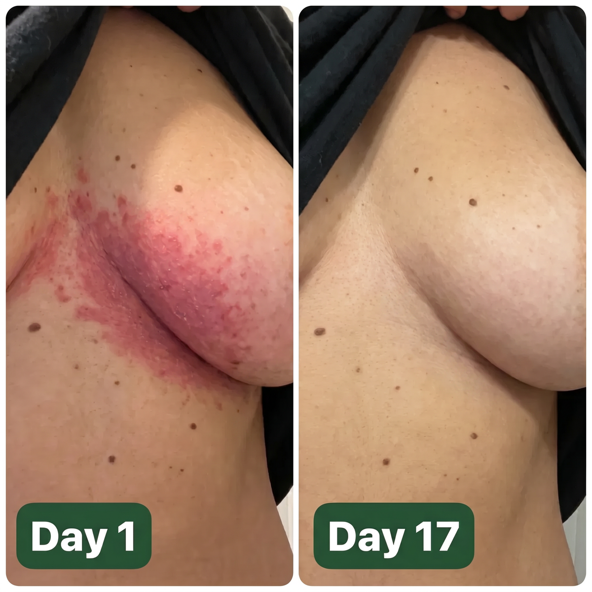 Antifungal Barrier Cream