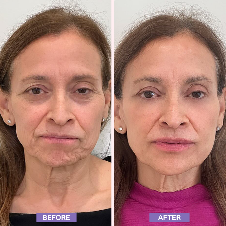 LIMETOW® Instant Lift Eye Gel