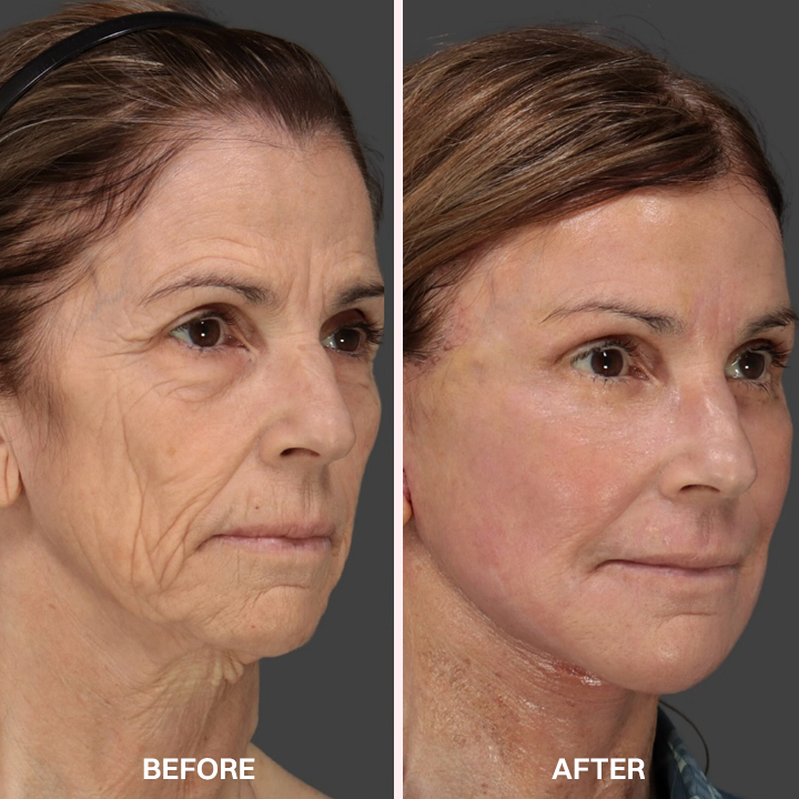 LIMETOW® Advanced Anti-Aging Serum