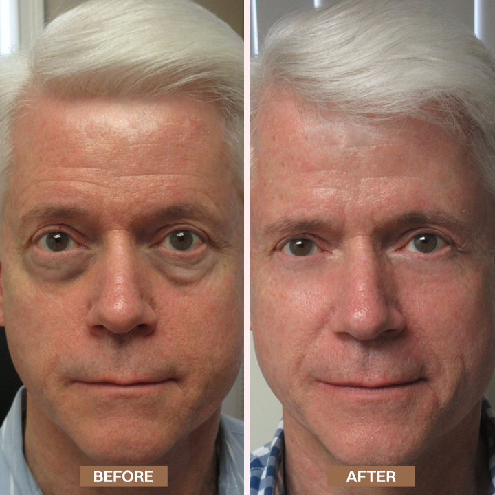 Limited-Time Offer⚡LIMETOW® Enhanse Under Eye Gel