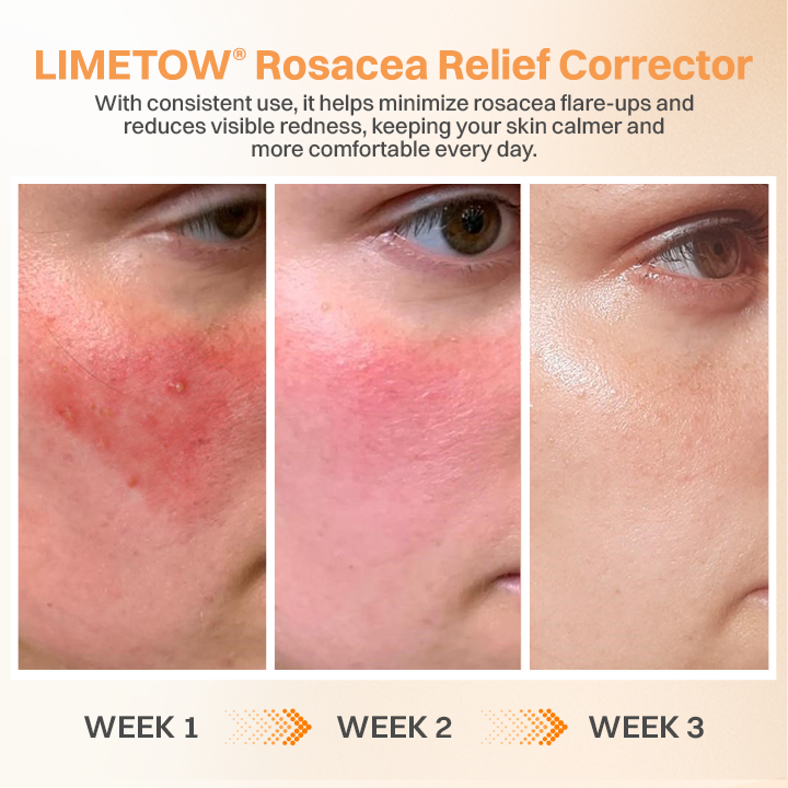 LIMETOW® Rosacea Relief Corrector