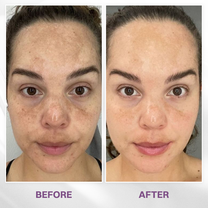 LIMETOW® Spot Refiner