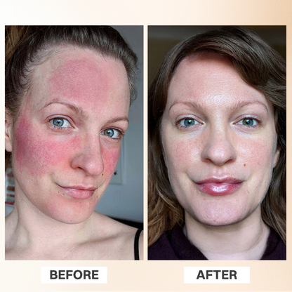 LIMETOW® Rosacea Relief Corrector