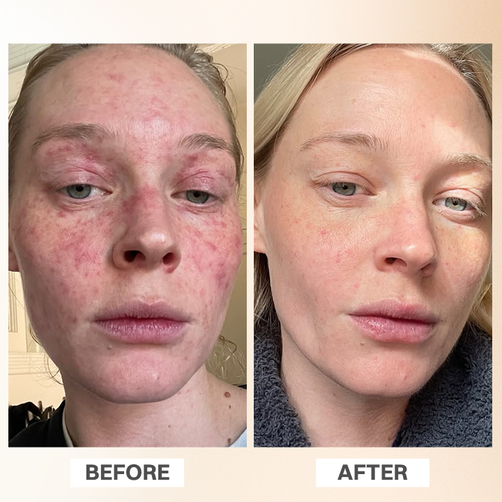LIMETOW® Rosacea Relief Corrector