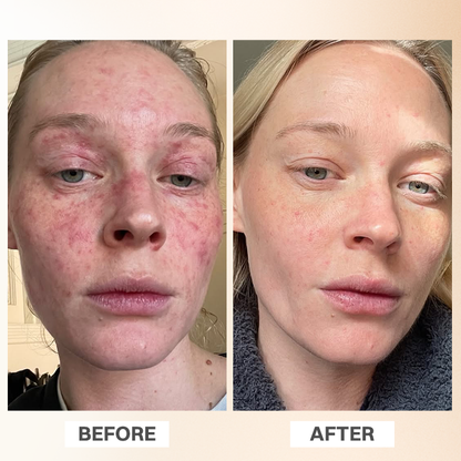 LIMETOW® Rosacea Relief Corrector