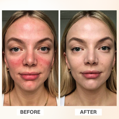 LIMETOW® Rosacea Relief Corrector