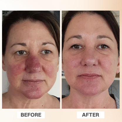 LIMETOW® Rosacea Relief Corrector