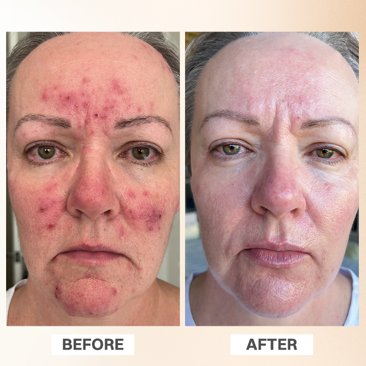 LIMETOW® Rosacea Relief Corrector