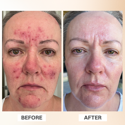 LIMETOW® Rosacea Relief Corrector
