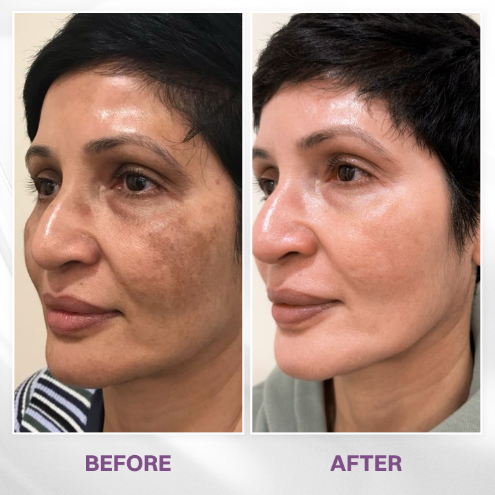 LIMETOW® Spot Refiner