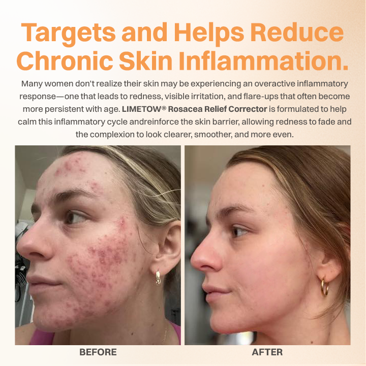 LIMETOW® Rosacea Relief Corrector
