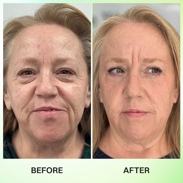 LIMETOW® Botox & Vita-A Retinol Shot Wrinkle-Lift Tightening Cream