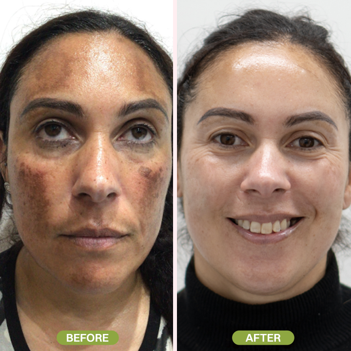 LIMETOW® Retinal Skin Booster Serum