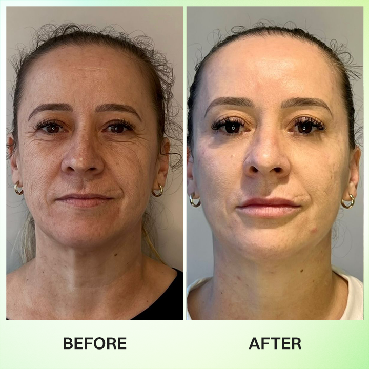 LIMETOW® Botox & Vita-A Retinol Shot Wrinkle-Lift Tightening Cream