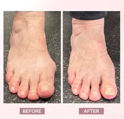LIMETOW® Bunion Relief Brace